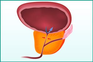 Vergrößerung der Prostata und Kompression der Harnröhre