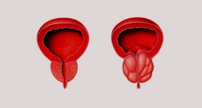 Gesunde (links) und entzündete Prostata durch Prostatitis (rechts)