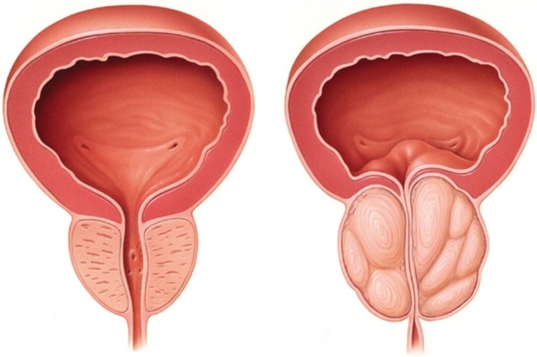 Normale Prostata (links) und mit Entzündungszeichen bei Prostatitis (rechts)
