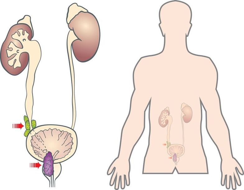 Symptome und Ursachen eines Prostataadenoms