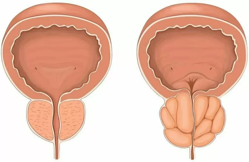 Normale Prostata und schmerzhafte Prostata