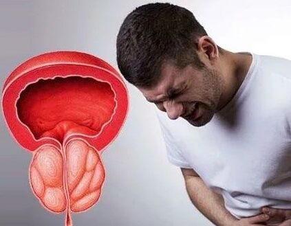 Symptome einer chronischen Prostatitis bei Männern