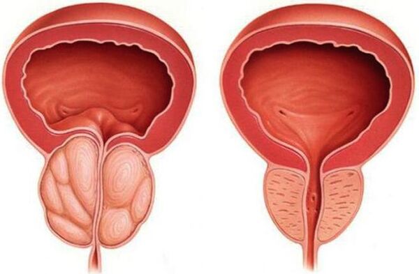 gesunde und entzündete Prostata mit Prostatitis